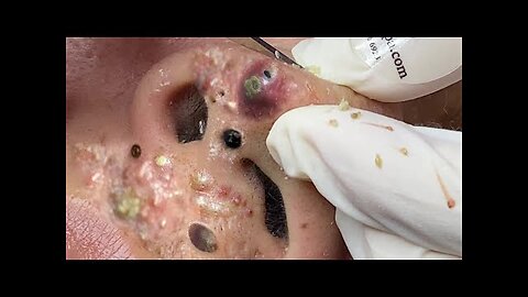 Blackheads Removal & Pimple Popper Cystic Acne Extraction 11