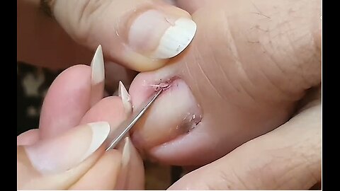 Cleaning is very needed! Home Service Pedicure Series #ingrowntoenail #toenails #pedicure (4)