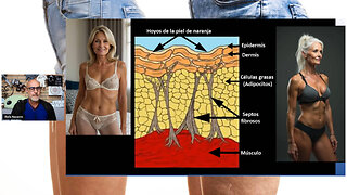 21-04-2025 - Celulitis Otro INVENTO de la farmacia moderna