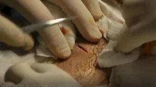 Alien Implant Removal