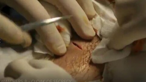 Alien Implant Removal