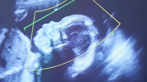 Empowering Parenthood: IVF & IUI Care at Sumathi Hospital