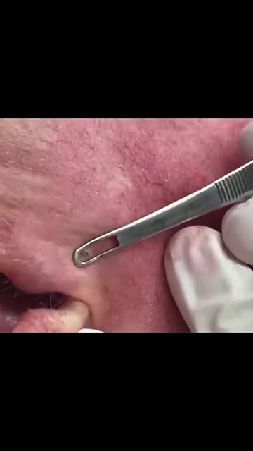 Dr Pimple Popper's Gnarly Pops!