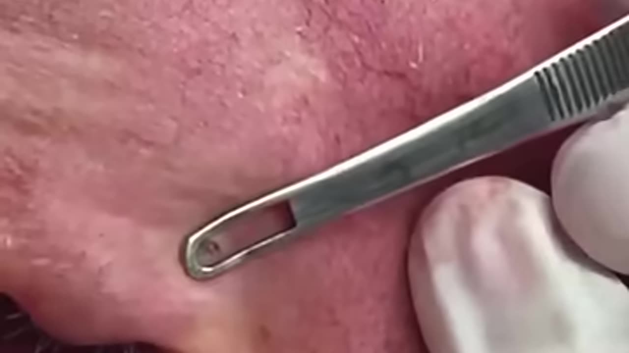 Dr Pimple Popper's Gnarly Pops!