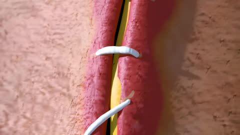 How Stitches Work