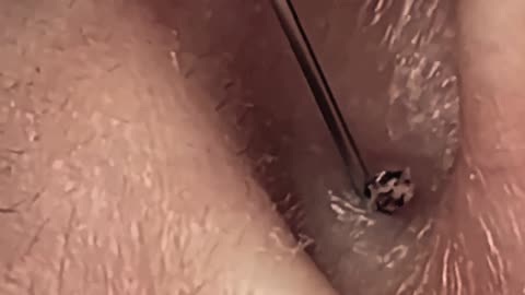 Relaxing pimple popping videos blackheads (ASMR) #1