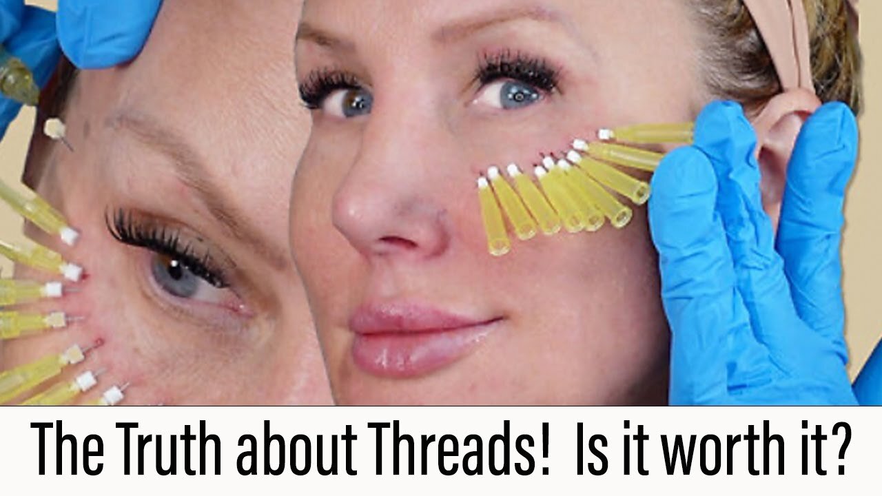 The Truth about Thread Lifts! Is It Worth It? #threadlift #facelift