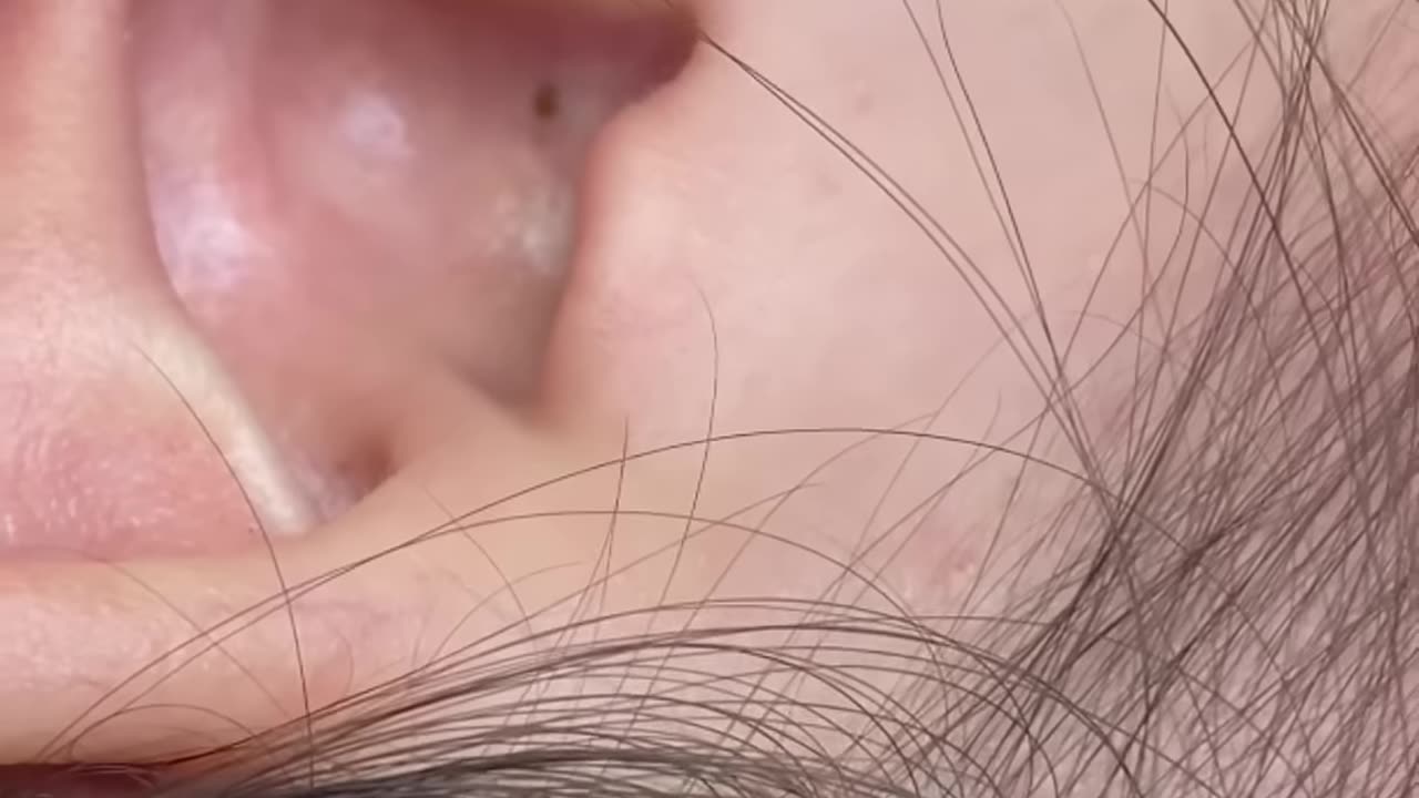 Pimple #sacdepspa