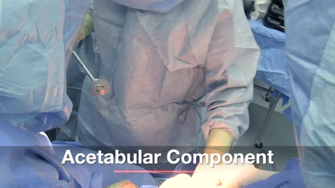 Scott A. Barbour, M.D. delivers with precision and care through total hip arthroplasty