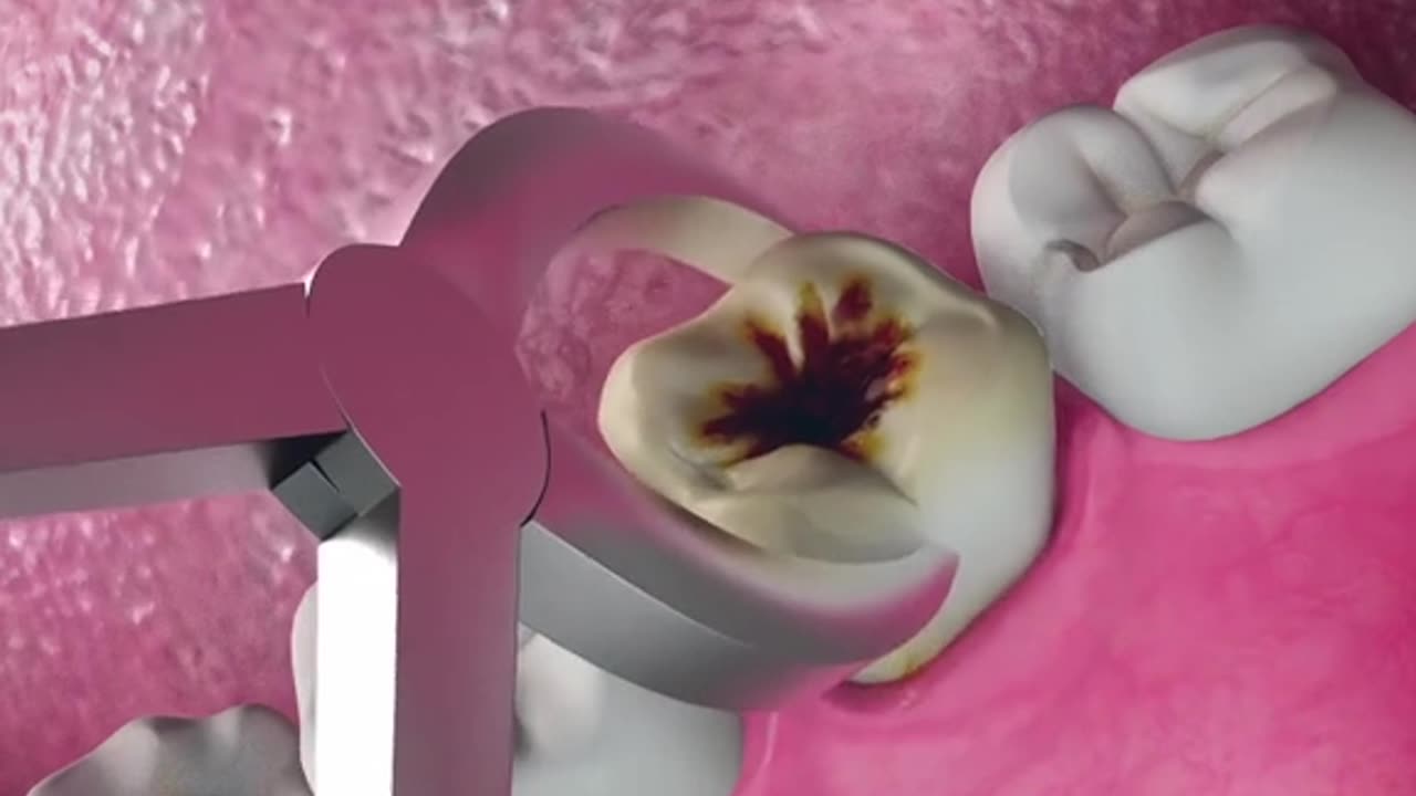 Tooth Extraction Process (3D Animation)