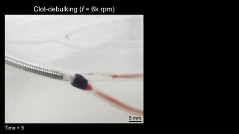 Scientists at Stanford have created a "milli-spinner" mechanical device to remove blood clots, specifically in the brain and lungs