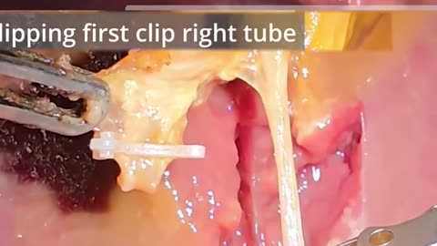 AI powered robot performs accurate surgery without human intervention