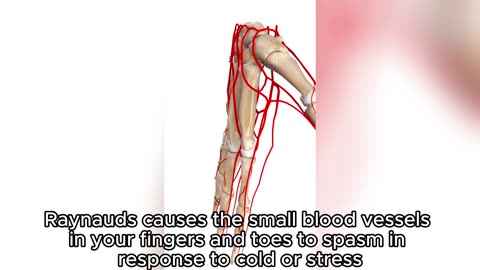 "Raynaud’s Phenomenon: Why Your Fingers Turn Blue in the Cold"
