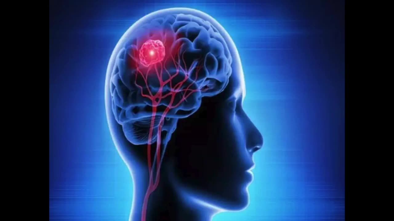 Muhammad Had Epilepsy: Here The Medical Case .