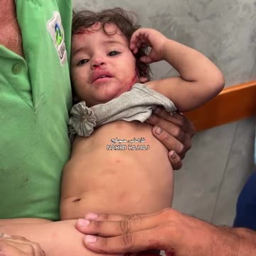 Injuries, including this little girl, were caused by targeting a tent sheltering displaced people