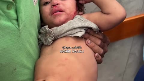 Injuries, including this little girl, were caused by targeting a tent sheltering displaced people