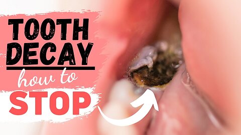 Dentist : How To Stop Tooth Cavities and Bleeding Gums