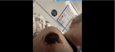 This lady's booster injection site is quickly eating her arm away. Huge black hole injury.
