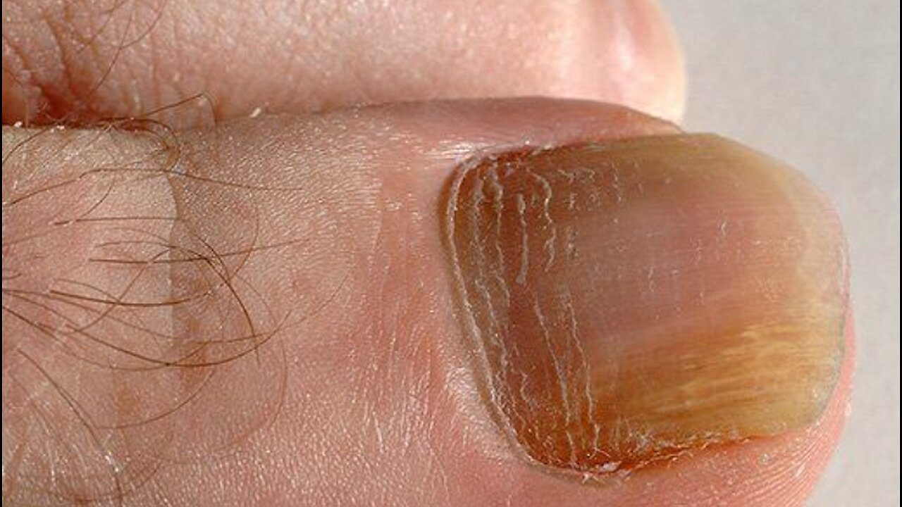 How To Prevent Nail Fungus (And Treat It If It's Already Present)