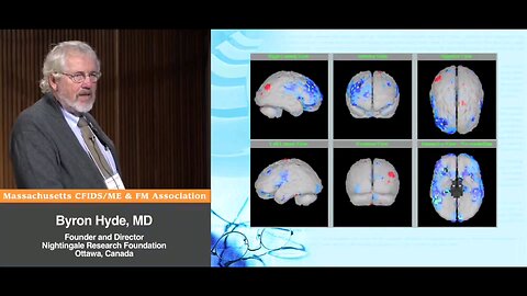 Segami Oasis NeuroGam Blood Perfusion SPECT Scans with "Myalgic Encephalomyelitis" (aka Enteroviral Encephalomyelitis) and "Acute Onset" CFS Patients - Byron Hyde, MD