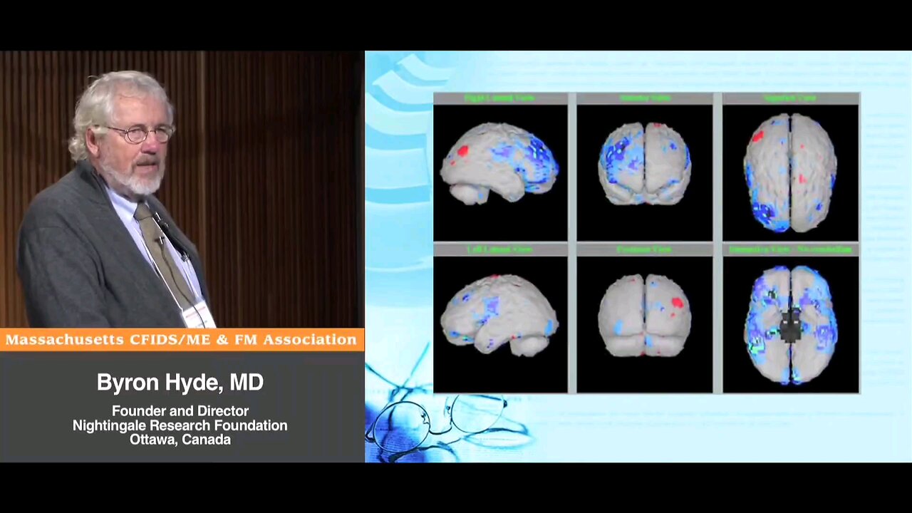 Segami Oasis NeuroGam Blood Perfusion SPECT Scans with "Myalgic Encephalomyelitis" (aka Enteroviral Encephalomyelitis) and "Acute Onset" CFS Patients - Byron Hyde, MD