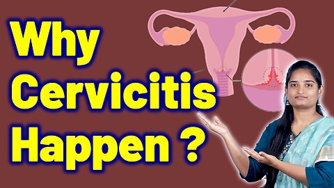 Causes For Cervicitis, Cervix Infection, Cervical Swelling | Homeopathy, Medicine Treatment & Cure