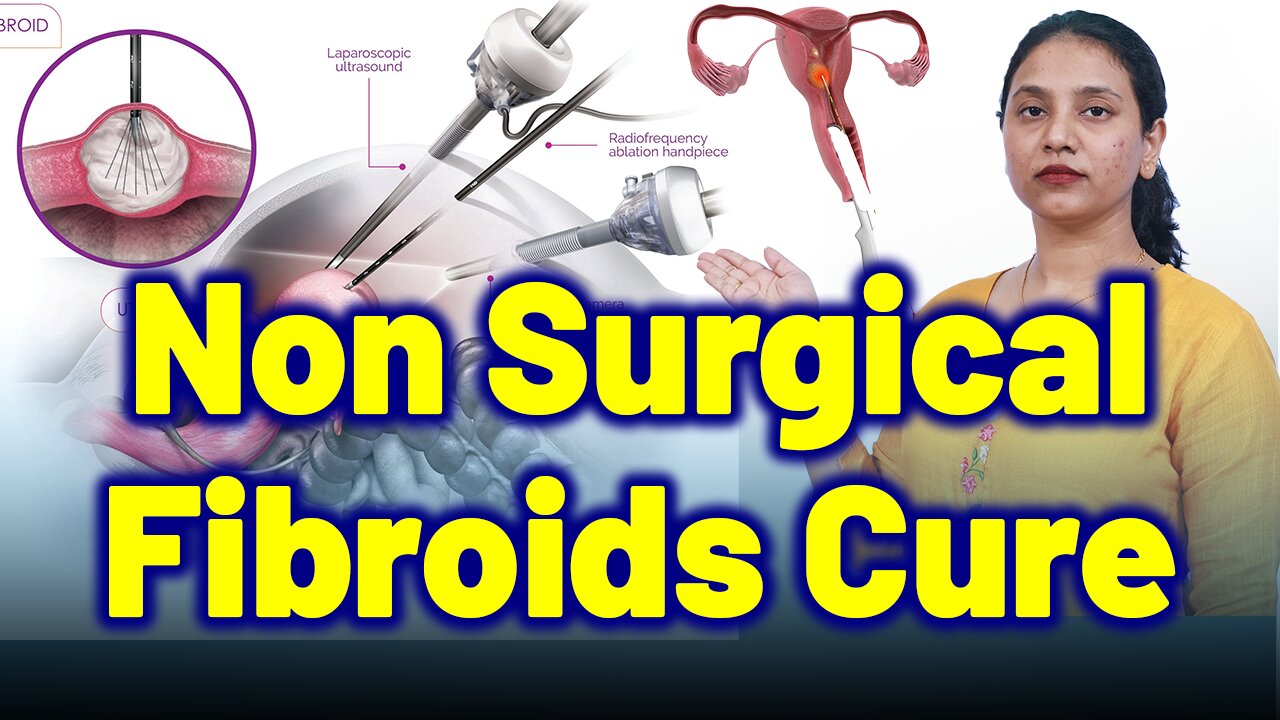Is Radio Frequency Ablation,Laparoscopic,Transvaginal,Ultrasound Safe for Fibroids? |Treatment &Cure