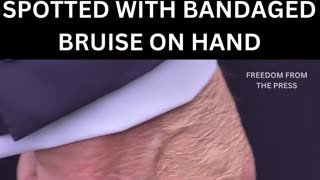 C-SPAN Captured Bruising on President Trump’s Hand Ahead of Major Economic Summit