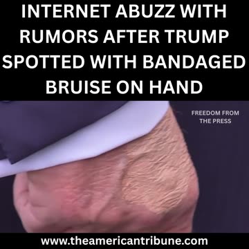 C-SPAN Captured Bruising on President Trump’s Hand Ahead of Major Economic Summit