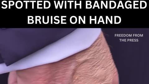C-SPAN Captured Bruising on President Trump’s Hand Ahead of Major Economic Summit