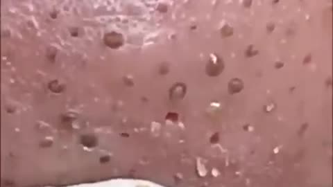 Blackhead Removal Animation