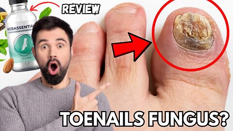 Toenail Fungus Won’t Go Away? Kerassentials May Be the Last Solution You Need!