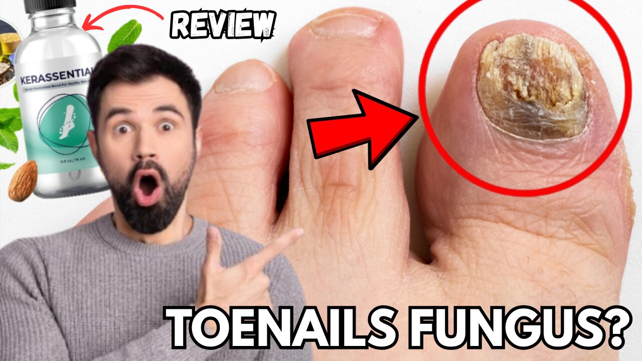 Toenail Fungus Won’t Go Away? Kerassentials May Be the Last Solution You Need!