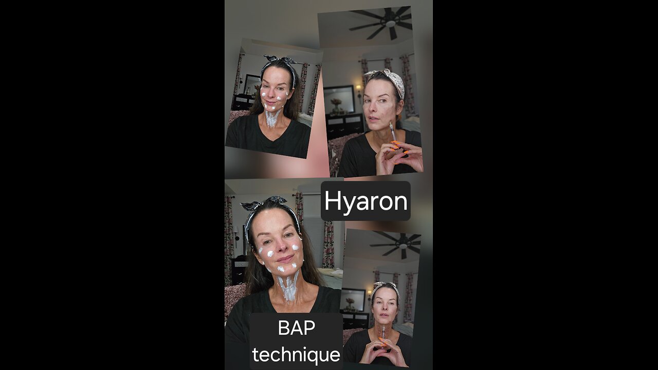 Hyaron BAP technique face and neck, hydration plus wrinkle reduction
