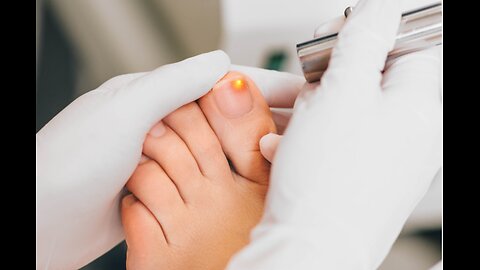 Ingrown Toenail Removal 2023 #ingrowntoenail #toenails #ingrown (20)