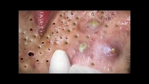 blackhead removal and Pimplepopper Spa relaxation #10113
