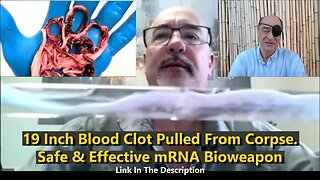 19 Inch Blood Clot Pulled From Corpse. Safe And Effective Bioweapon Injection!