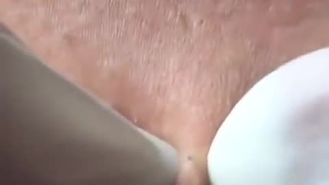Acne chest ( part 2)