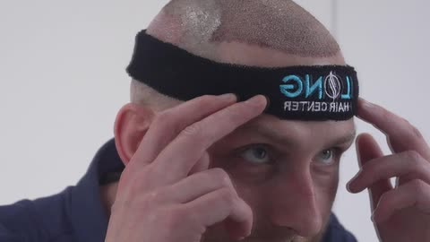 Here’s a step-by-step moment as we create a natural hairline for one of our patients.