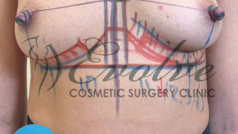 2.5 Years After Breast Augmentation | 325ml Medium Profile Implants with Inframammary Access