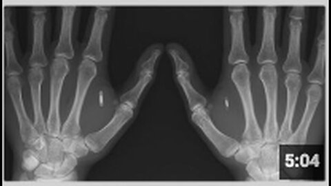 "CBDCs Will Be Implanted Chips, Warns Banking Insider Greg Reese"