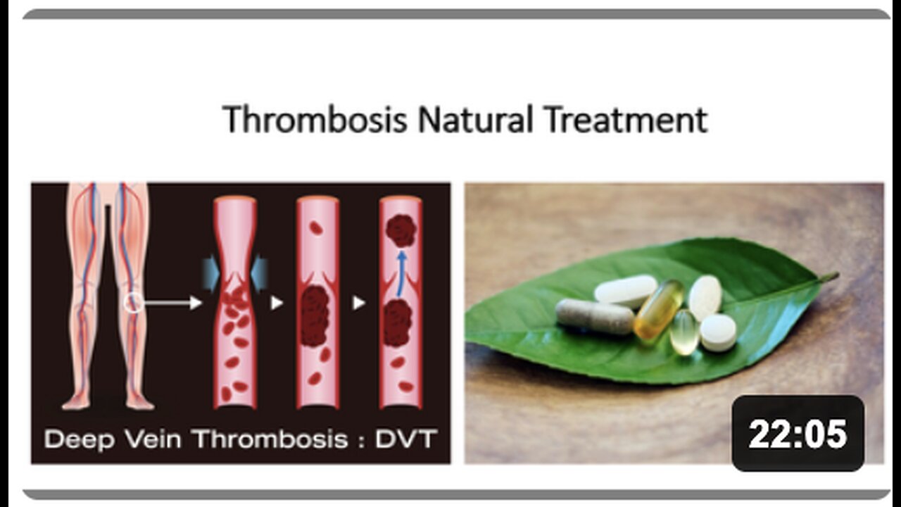 Thrombosis Natural Treatment