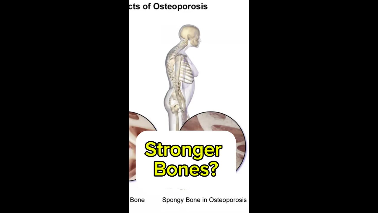 Common CAUSES of Osteoporosis?