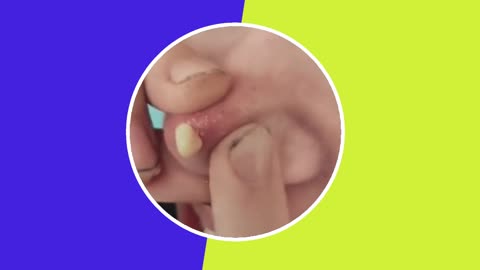 Pimple removal satisfying video (ASMR) #3