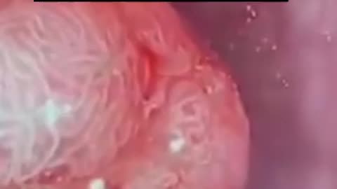 Colon cancer tumour close-up