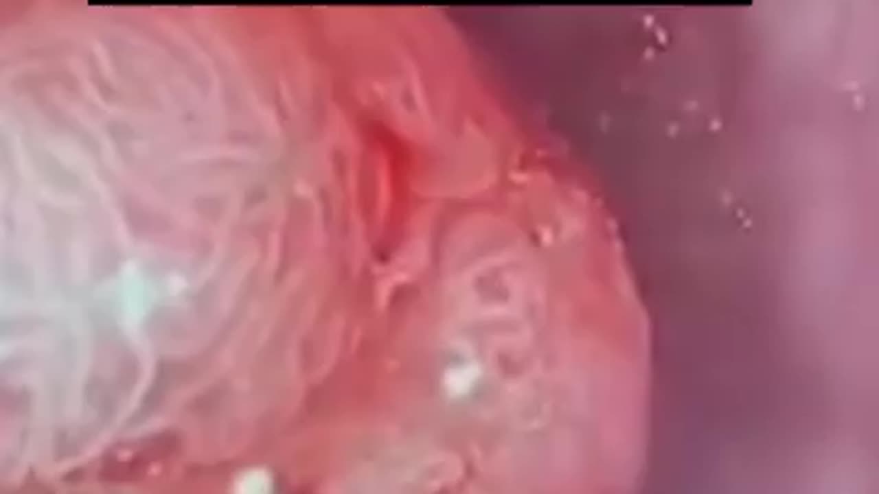 Colon cancer tumour close-up