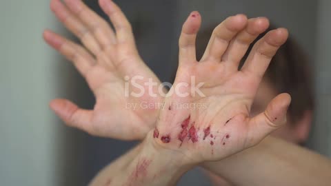 Survive a Snake Bite- Essential Steps