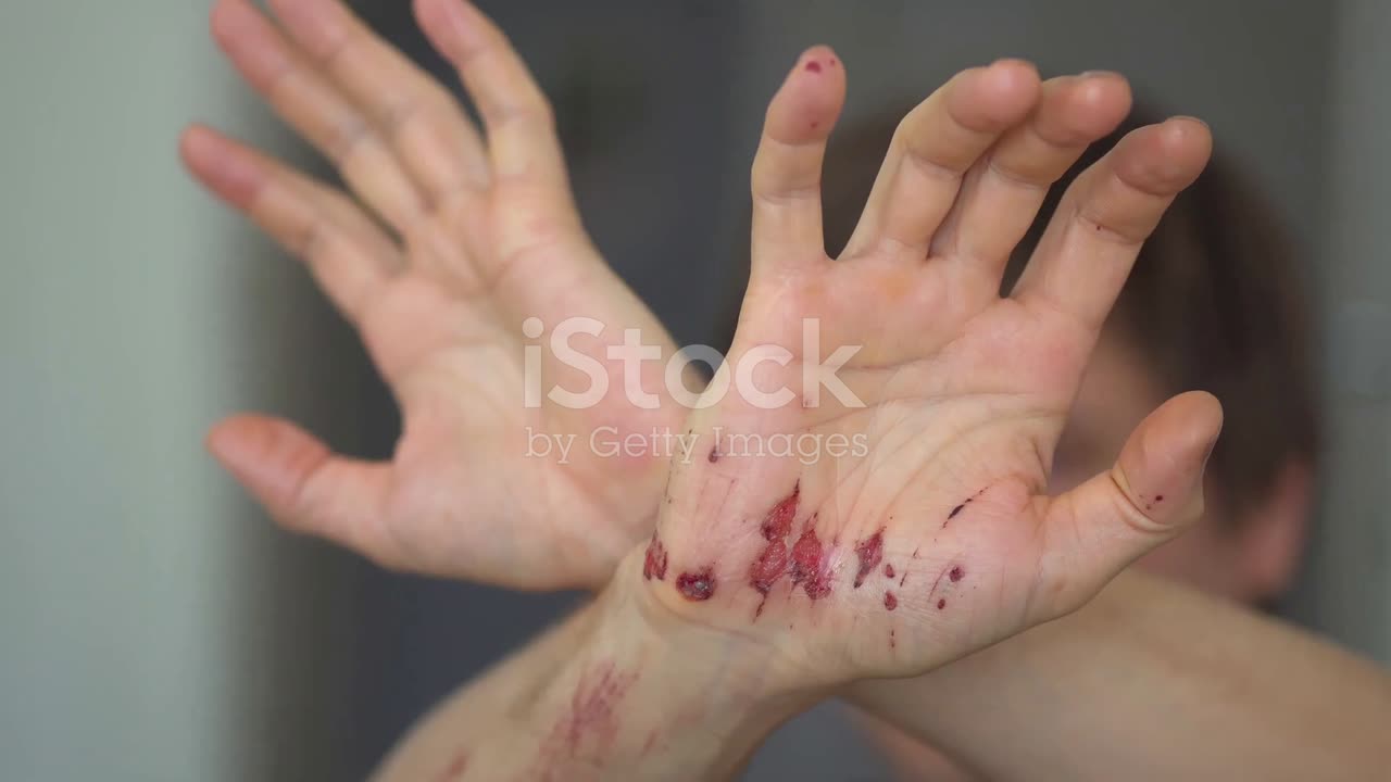 Survive a Snake Bite- Essential Steps