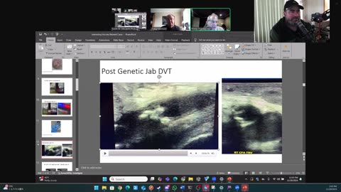 (CLIP) High Amyloidogenicity in Post-Mortem 'Calamari' Clots, Deep Vein Thrombosis (Leg) Post-Vax