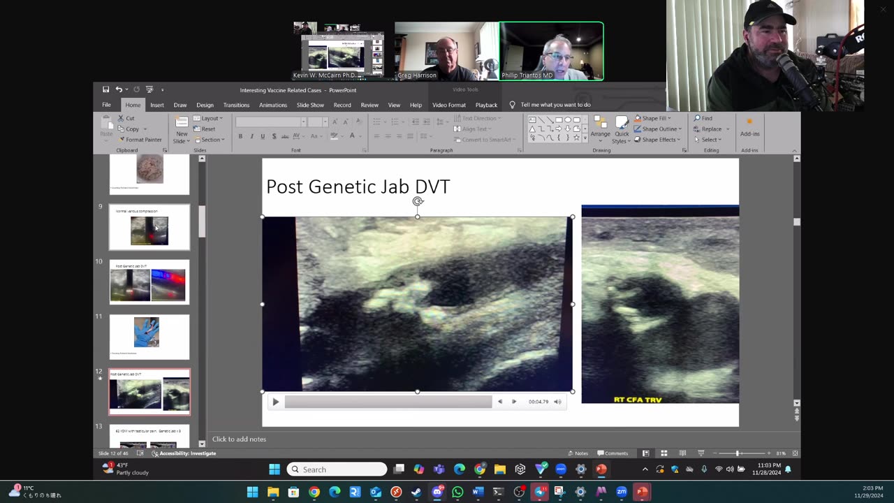 (CLIP) High Amyloidogenicity in Post-Mortem 'Calamari' Clots, Deep Vein Thrombosis (Leg) Post-Vax